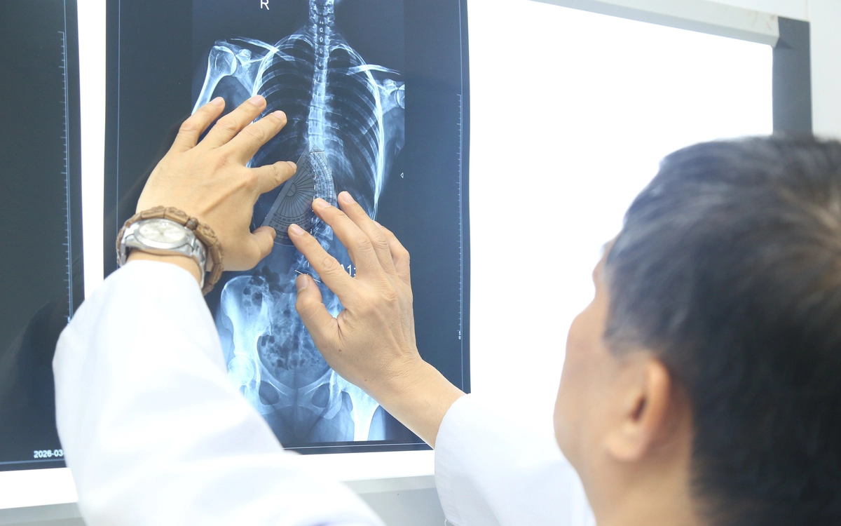 Nhiều trẻ vẹo cột sống nặng mới đi khám, chuyên gia cảnh báo nguy cơ biến chứng nặng