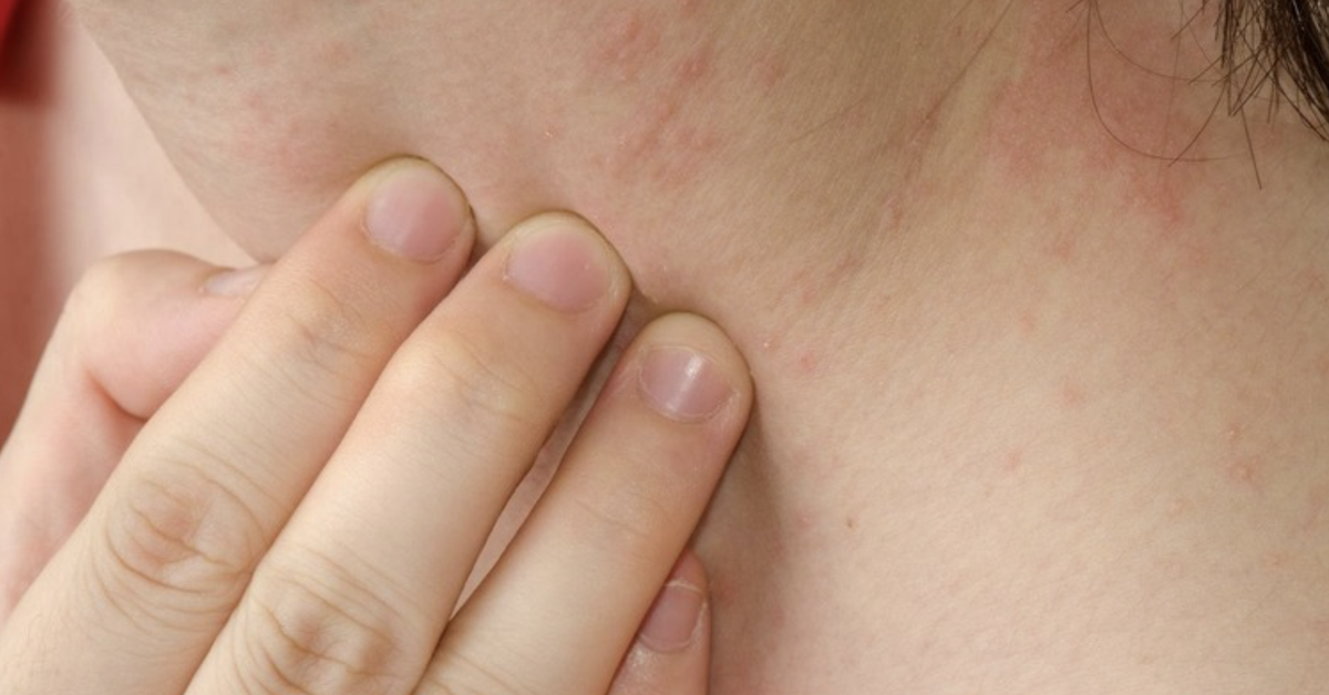 Ngứa kéo dài có thể là dấu hiệu cảnh báo sớm suy thận