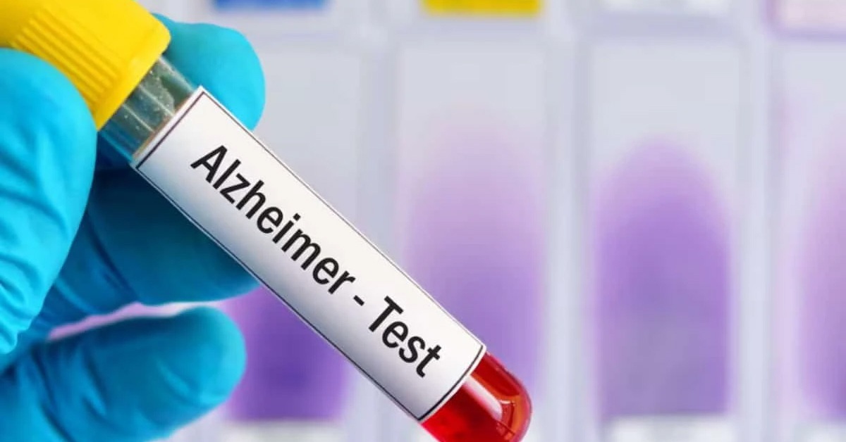 Bộ xét nghiệm máu mới giúp phát hiện sớm bệnh Alzheimer