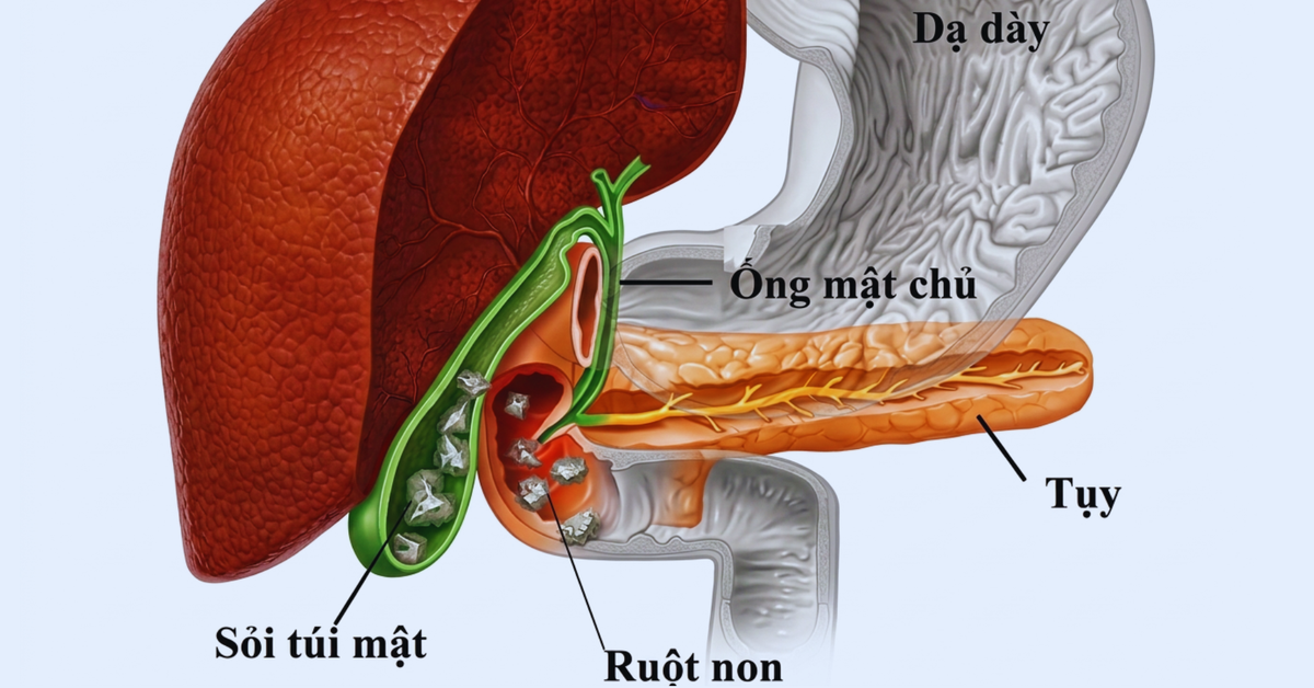 Ăn gì để ngăn ngừa bệnh sỏi mật?