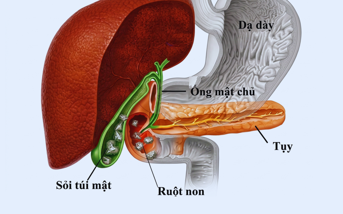 Ăn gì để ngăn ngừa bệnh sỏi mật?