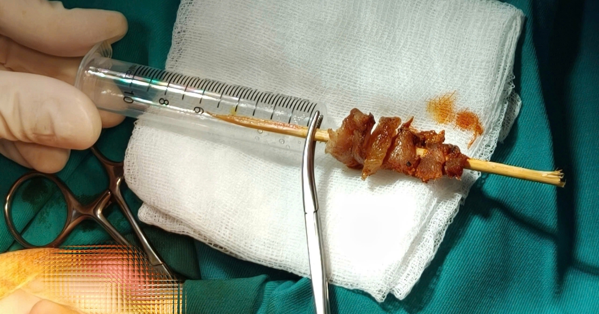 Chạy nhảy, bé gái bị que xiên thịt đâm sâu suýt xuyên sọ não