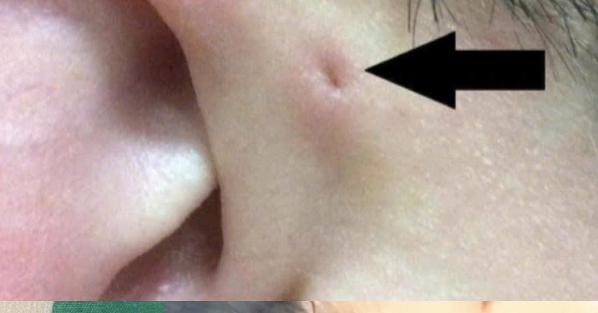 Gia đình 3 thế hệ cùng mắc bệnh ít gặp rò luân nhĩ: Bệnh có nguy hiểm không?