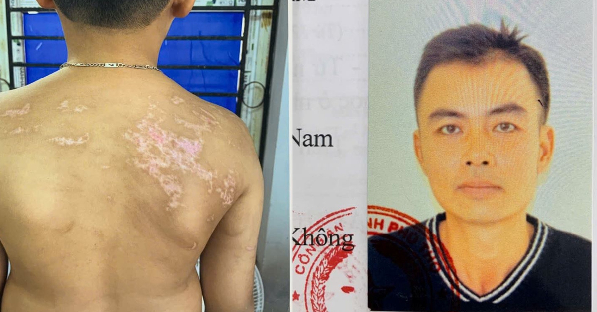 Khởi tố người cha đánh con ruột gây thương tích 36%