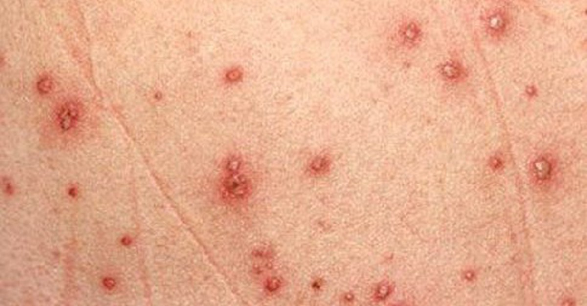 Vắc xin có từ lâu, vì sao ca nhập viện do thủy đậu vẫn tăng?