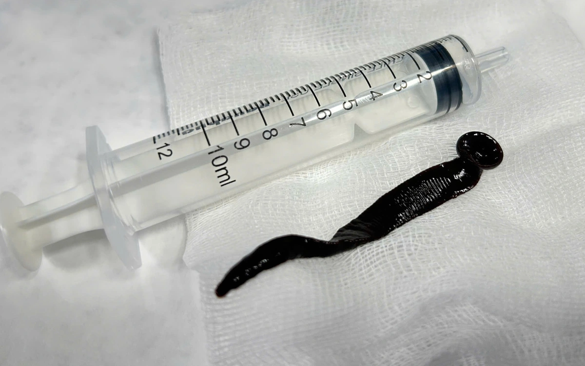 Doctors remove live 12cm leech from 8-year-old boy's airway in Quang Ngai