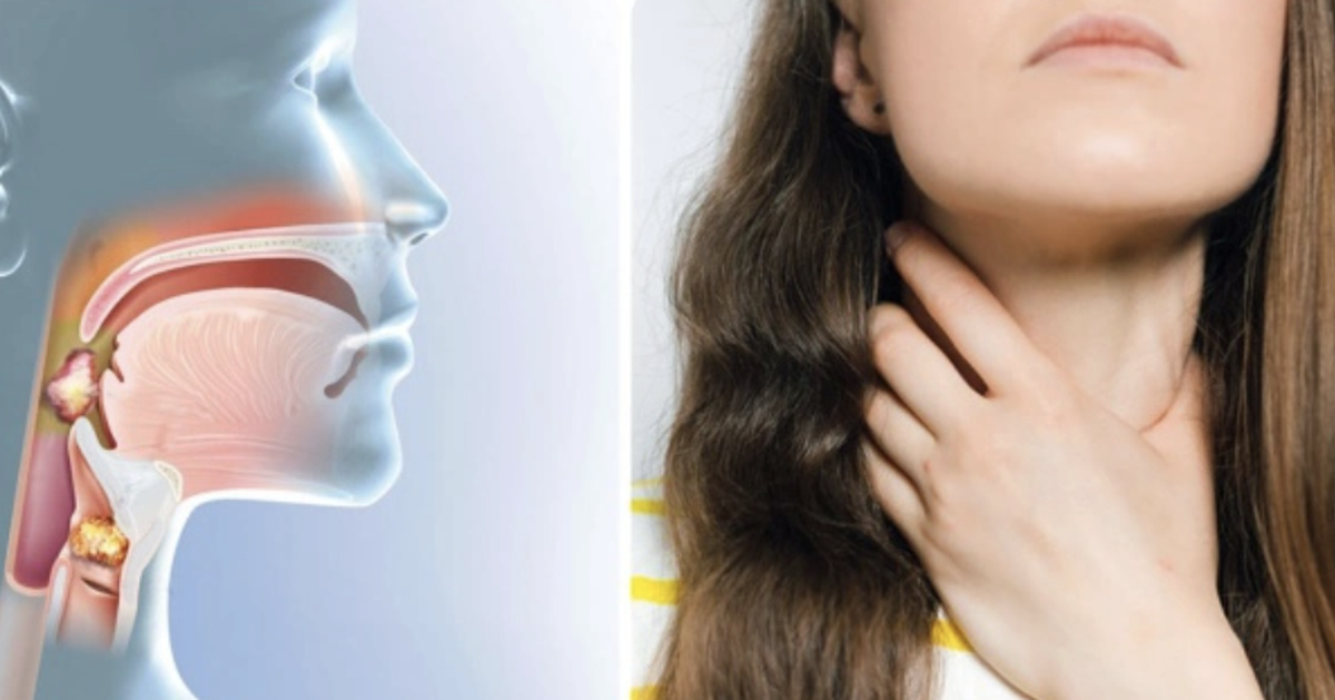 Triệu chứng ung thư vòm họng dễ nhầm với viêm họng, viêm xoang