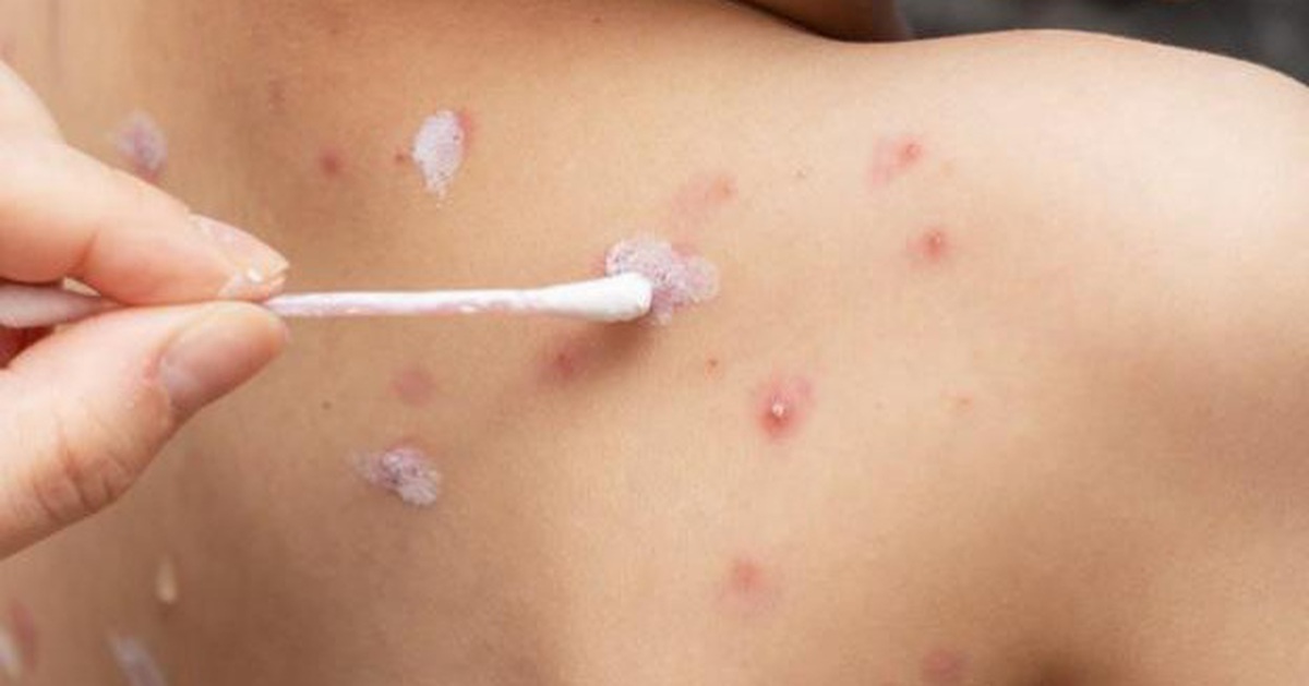 Cần xóa bỏ lầm tưởng ‘thủy đậu là bệnh nhẹ, dễ lành’