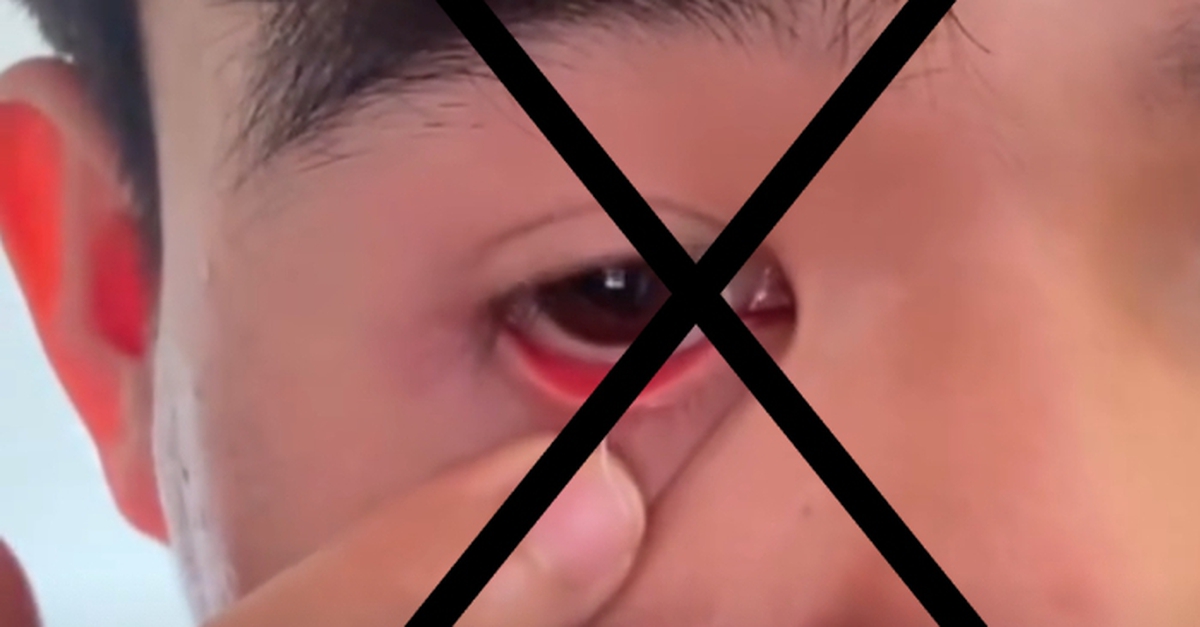 Chiêu trò lôi 'ký sinh trùng' ra từ mắt