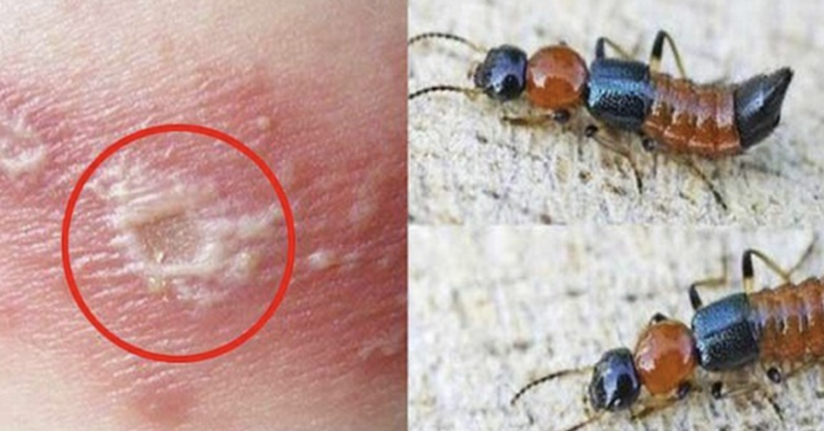 Mùa kiến ba khoang, cẩn trọng nhầm với zona thần kinh