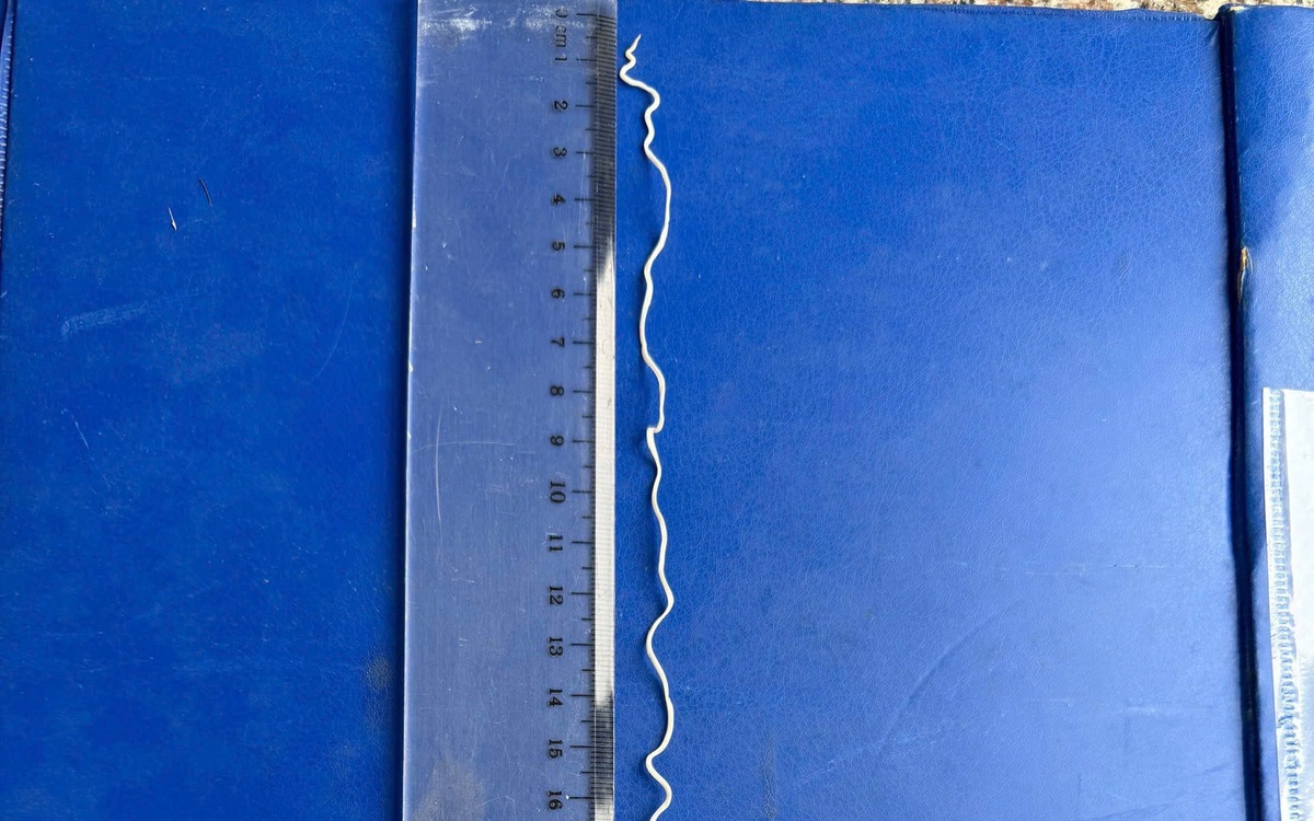 Tự nặn mụn trên cánh tay, phát hiện con giun rồng dài 20cm dưới da