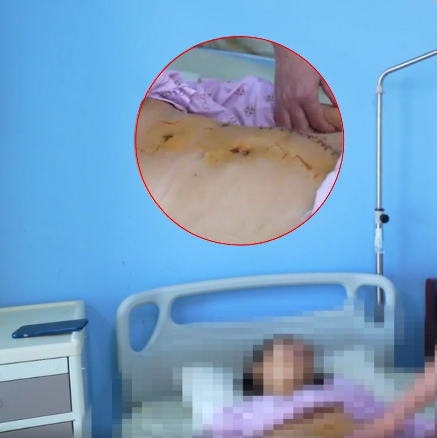 Ca mổ hy hữu, lấy thận ra khỏi cơ thể người phụ nữ trẻ để 'sửa chữa' rồi ghép lại