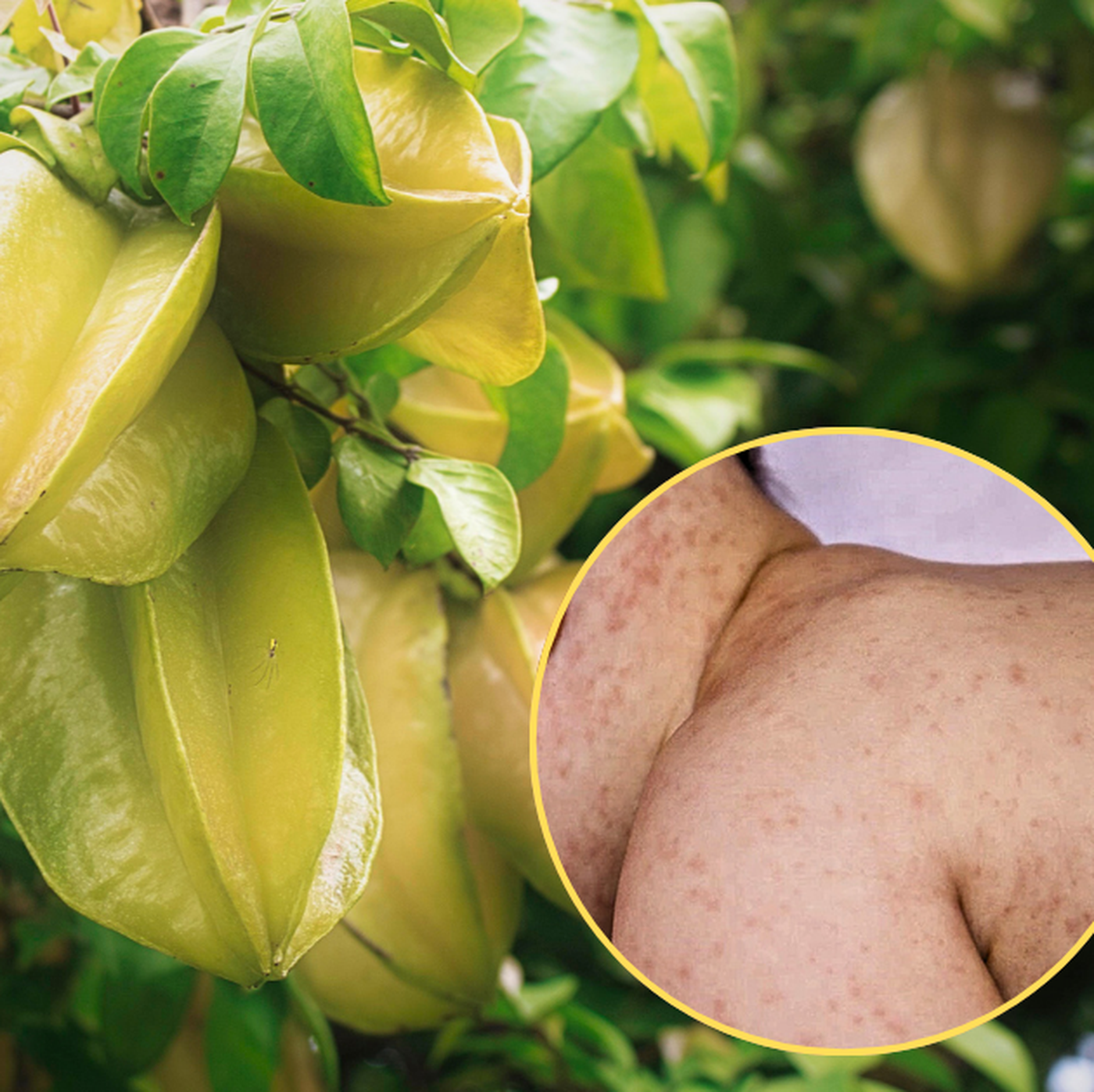 Bé 10 ngày tuổi nổi mụn mủ li ti vì tắm bằng nước lá khế Bé 10 ngày tuổi nổi mụn mủ li ti vì tắm bằng nước lá khế