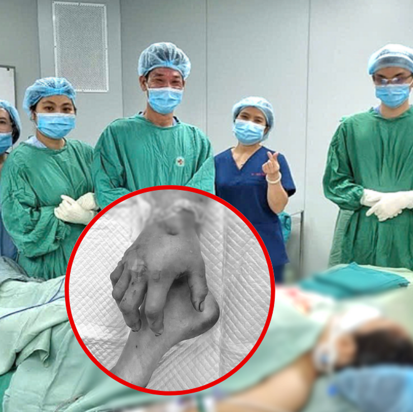 Nối thành công bàn tay cho sản phụ sau gần hai tháng ‘nuôi chi’ ở cẳng chân