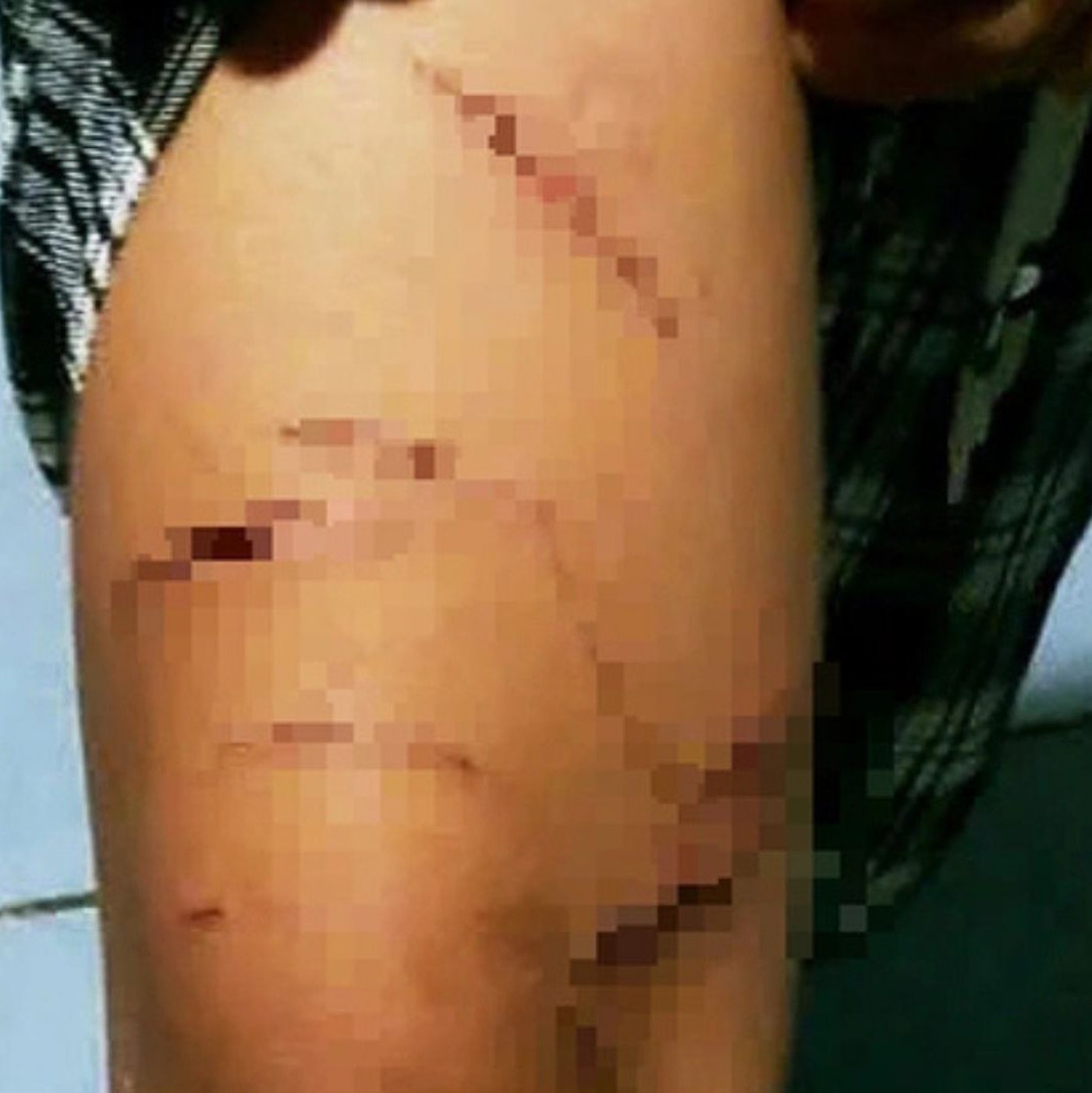 Người nhà lên tiếng vụ bé gái lớp 5 nghi bị chị họ rạch nhiều vết thương