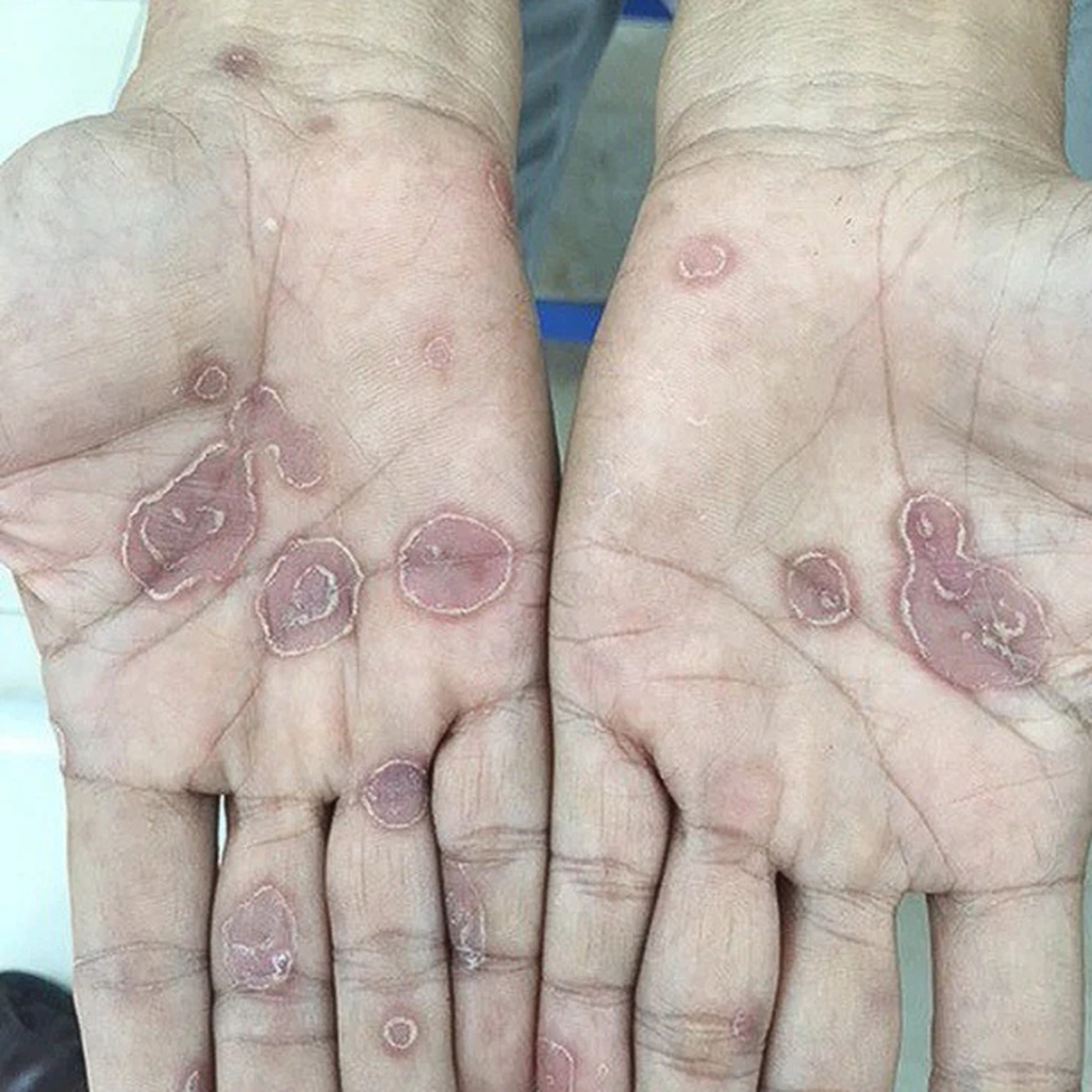 Giả thuyết mới về nguồn gốc bệnh giang mai, có thể đã xuất hiện ở Việt Nam hàng ngàn năm episode artwork