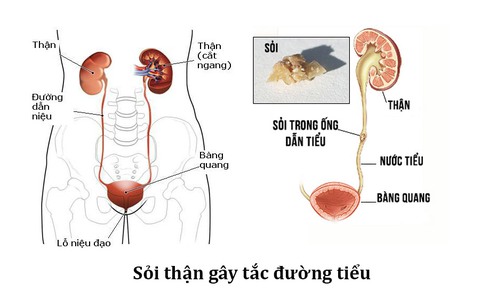 Những biến chứng nguy hiểm của bệnh sỏi thận, bạn có biết? - Ảnh 2. Những biến chứng nguy hiểm của bệnh sỏi thận, bạn có biết? - Ảnh 2.