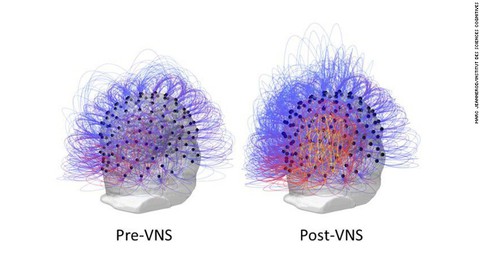 Lần đầu tiên trên thế giới: phục hồi cho bệnh nhân sống thực vật - Ảnh 2. Lần đầu tiên trên thế giới: phục hồi cho bệnh nhân sống thực vật - Ảnh 2.