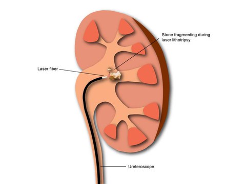 Lấy sỏi thận sao cho nhanh, ít di chứng? - Ảnh 1. Lấy sỏi thận sao cho nhanh, ít di chứng? - Ảnh 1.