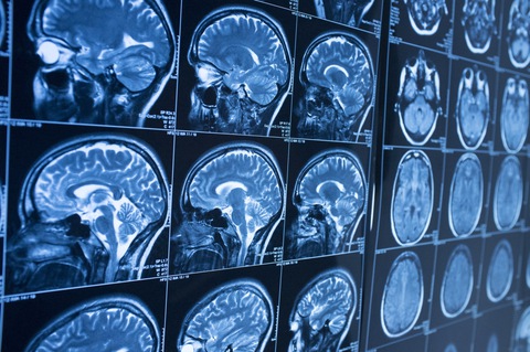 Có thể dự báo bệnh Alzheimer trước 10 năm - Ảnh 1. Có thể dự báo bệnh Alzheimer trước 10 năm - Ảnh 1.
