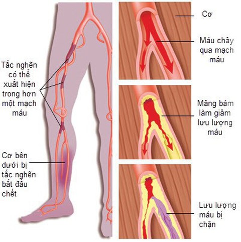 Tắc động mạch ngoại biên: âm thầm nhưng nguy hiểm - Ảnh 1. Tắc động mạch ngoại biên: âm thầm nhưng nguy hiểm - Ảnh 1.