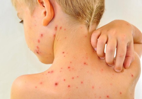 Cần cảnh giác bệnh sởi khi thời tiết chuyển mùa đông - xuân - Ảnh 1. Cần cảnh giác bệnh sởi khi thời tiết chuyển mùa đông - xuân - Ảnh 1.