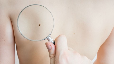 Nốt ruồi hay u hắc tố? - Ảnh 1. Nốt ruồi hay u hắc tố? - Ảnh 1.