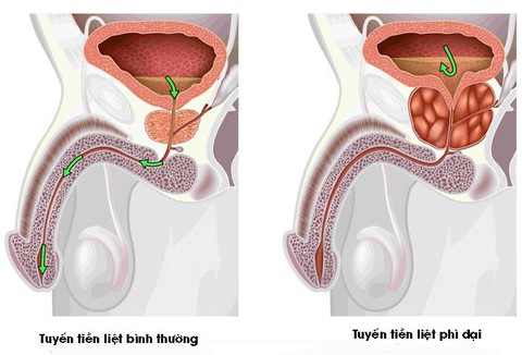U xơ tuyến tiền liệt - nỗi lo của nam giới tuổi trung niên - Ảnh 1. U xơ tuyến tiền liệt - nỗi lo của nam giới tuổi trung niên - Ảnh 1.