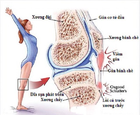 Vài điều cần biết về viêm gân bánh chè - Ảnh 1. Vài điều cần biết về viêm gân bánh chè - Ảnh 1.