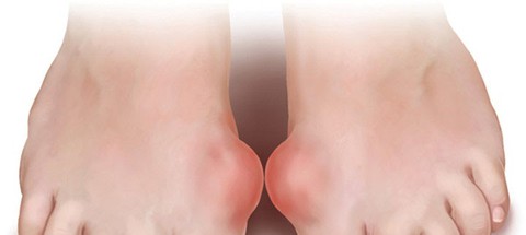Bệnh gout và cách hạn chế bệnh gout - Ảnh 1. Bệnh gout và cách hạn chế bệnh gout - Ảnh 1.