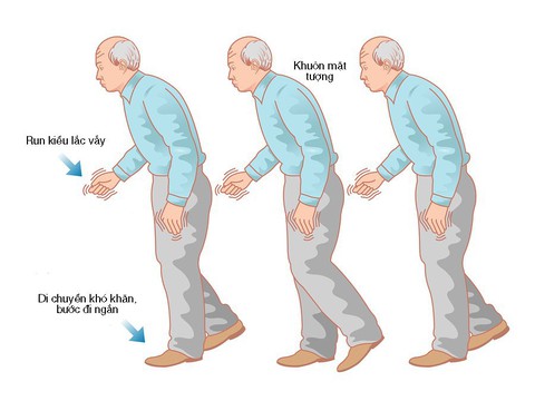 Những điều cần biết về bệnh Parkinson - Ảnh 1. Những điều cần biết về bệnh Parkinson - Ảnh 1.
