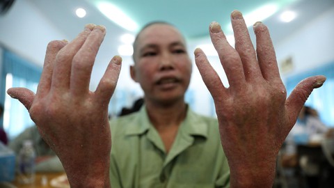 Không nên kỳ thị người bị vảy nến - Ảnh 1. Không nên kỳ thị người bị vảy nến - Ảnh 1.