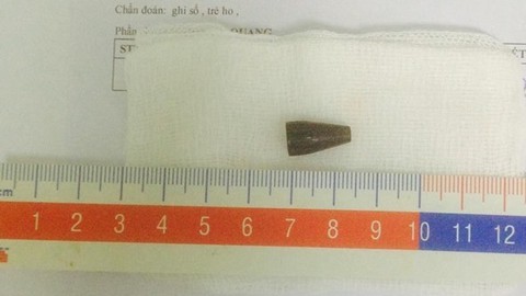 Bé trai bị đầu bút bi rơi vào đường thở - Ảnh 1. Bé trai bị đầu bút bi rơi vào đường thở - Ảnh 1.