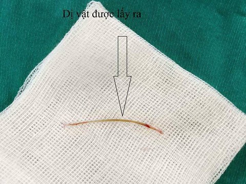 Xương cá dài 4cm đâm thủng ruột cụ bà 72 tuổi - Ảnh 1. Xương cá dài 4cm đâm thủng ruột cụ bà 72 tuổi - Ảnh 1.