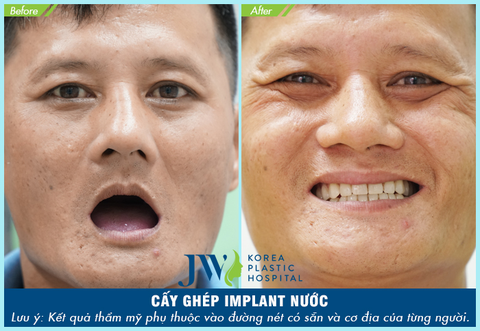Trải nghiệm công nghệ cấy ghép Implant Thế giới tại Việt Nam - Ảnh 4. Trải nghiệm công nghệ cấy ghép Implant Thế giới tại Việt Nam - Ảnh 4.