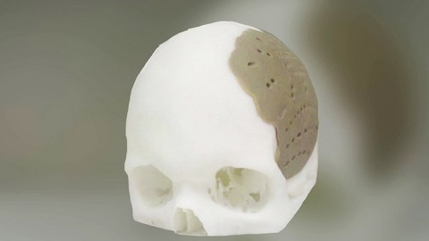 In 3D đang tạo ra phép màu trong y học - Ảnh 5. In 3D đang tạo ra phép màu trong y học - Ảnh 5.