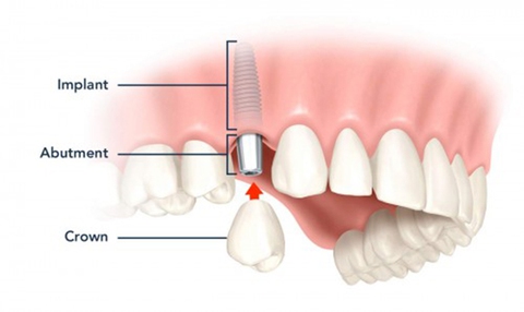 Kỹ thuật cấy ghép răng giả cùng lúc nhổ răng thật - Ảnh 1. Kỹ thuật cấy ghép răng giả cùng lúc nhổ răng thật - Ảnh 1.