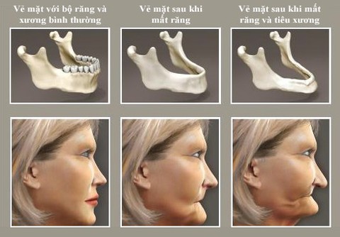 Điều kỳ diệu, răng đã mất “mọc lại” chỉ 4 tuần - Ảnh 1. Điều kỳ diệu, răng đã mất “mọc lại” chỉ 4 tuần - Ảnh 1.