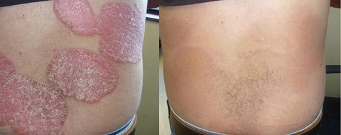 Cải thiện chất lượng cuộc sống ở bệnh nhân vảy nến - Ảnh 2. Cải thiện chất lượng cuộc sống ở bệnh nhân vảy nến - Ảnh 2.