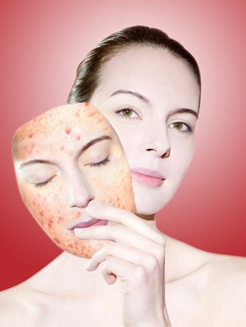 Điều trị mụn đột phá sau 3 ngày với công nghệ Nano hàng đầu của Mỹ - Ảnh 1. Điều trị mụn đột phá sau 3 ngày với công nghệ Nano hàng đầu của Mỹ - Ảnh 1.