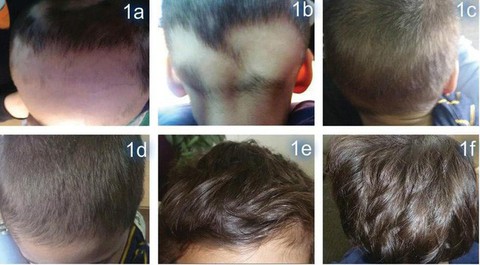 Chống rụng tóc từng vùng bằng thảo dược - Ảnh 2. Chống rụng tóc từng vùng bằng thảo dược - Ảnh 2.