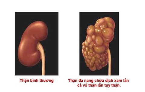 Làm thế nào phát hiện sớm bệnh thận - Ảnh 1. Làm thế nào phát hiện sớm bệnh thận - Ảnh 1.