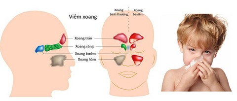 Viêm xoang mạn tính kéo dài do trào ngược dạ dày-thực quản - Ảnh 1. Viêm xoang mạn tính kéo dài do trào ngược dạ dày-thực quản - Ảnh 1.