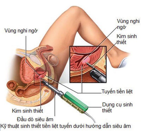 Ung thư tuyến tiền liệt - Ảnh 1. Ung thư tuyến tiền liệt - Ảnh 1.