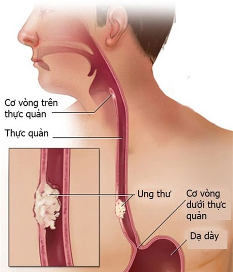 Nuốt khó là triệu chứng thường gặp của ung thư thực quản - Ảnh 1. Nuốt khó là triệu chứng thường gặp của ung thư thực quản - Ảnh 1.