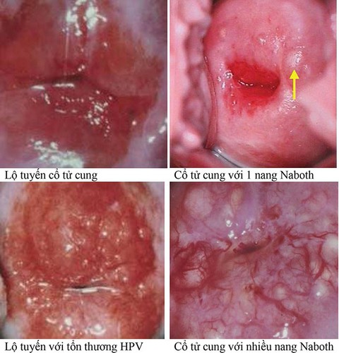 Khi nào cần điều trị lộ tuyến hoặc nang Naboth cổ tử cung? - Ảnh 1. Khi nào cần điều trị lộ tuyến hoặc nang Naboth cổ tử cung? - Ảnh 1.