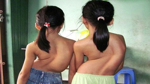 Cong vẹo cột sống ở lứa tuổi học đường - Ảnh 1. Cong vẹo cột sống ở lứa tuổi học đường - Ảnh 1.
