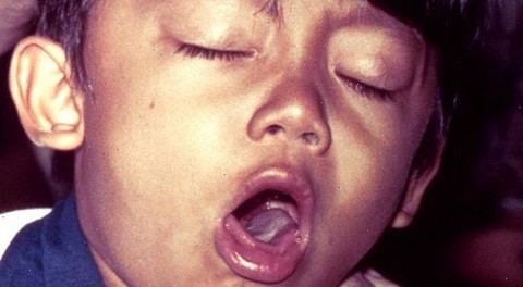 Ho gà thường xảy ra vào mùa lạnh - Ảnh 1. Ho gà thường xảy ra vào mùa lạnh - Ảnh 1.