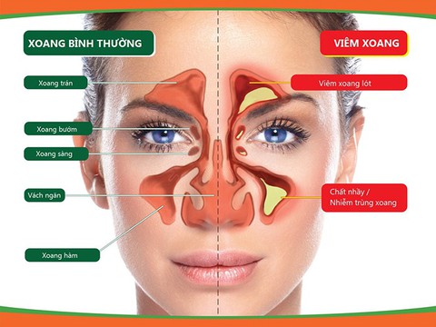 Viêm xoang có thể gây ra những biến chứng nguy hiểm - Ảnh 1. Viêm xoang có thể gây ra những biến chứng nguy hiểm - Ảnh 1.