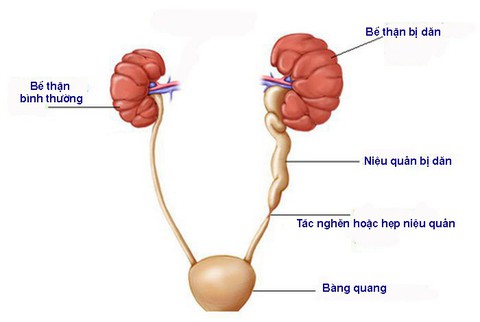 Những giải pháp tích cực khi bị thận ứ nước - Ảnh 1. Những giải pháp tích cực khi bị thận ứ nước - Ảnh 1.